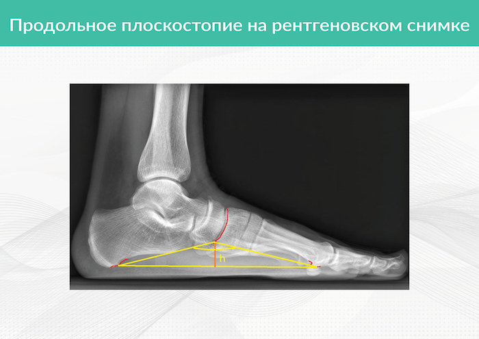 Рентген стопы в двух проекциях. Рентген стоп на продольное плоскостопие. Как обмануть рентген стоп.