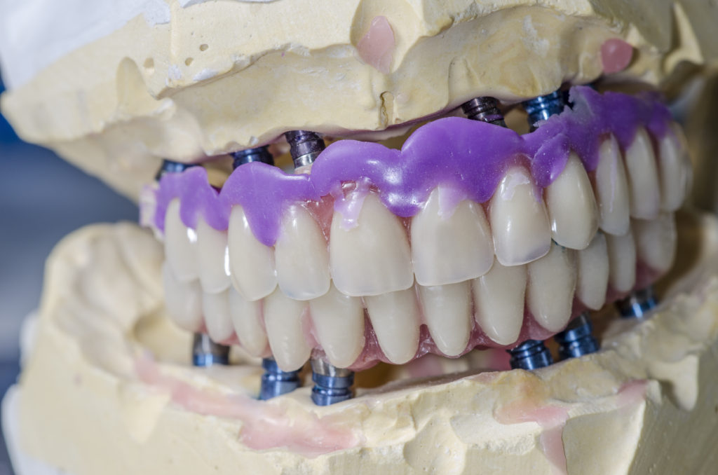 Мост на имплантах на 4 зуба фото