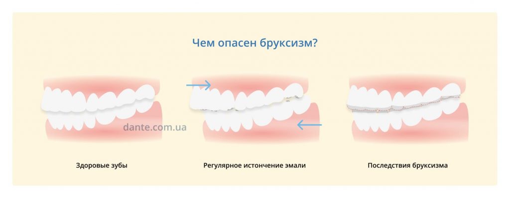 Ребенок скрипит зубами во сне причины. Симптомы бруксизма у взрослого. Последствия бруксизма.