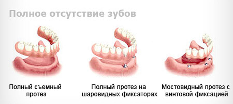 Какие способы протезирования зубов бывают с картинками