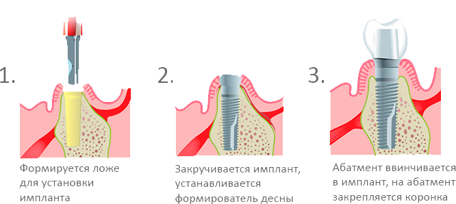 Через сколько после удаления зуба ставят имплант. Установка формирователя десны методика. Абатмент в стоматологии. Зазор между имплантом и абатментом.