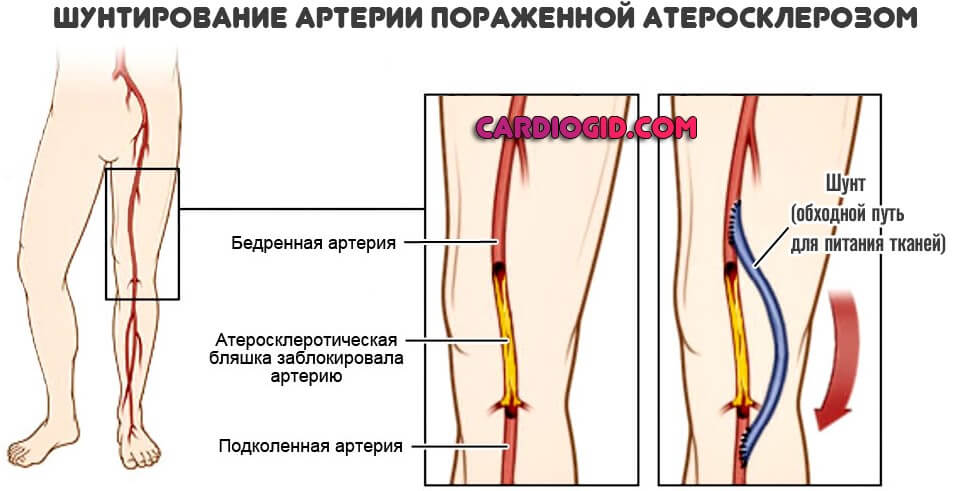 Бедренная артерия. Атеросклероз бедренной артерии. Шунтирование атеросклероза. Шунтирование артерий голени. Шунтирование атеросклероза нижних конечностей.