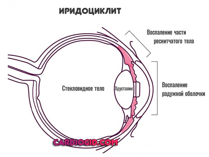 Иридоциклит схема лечения