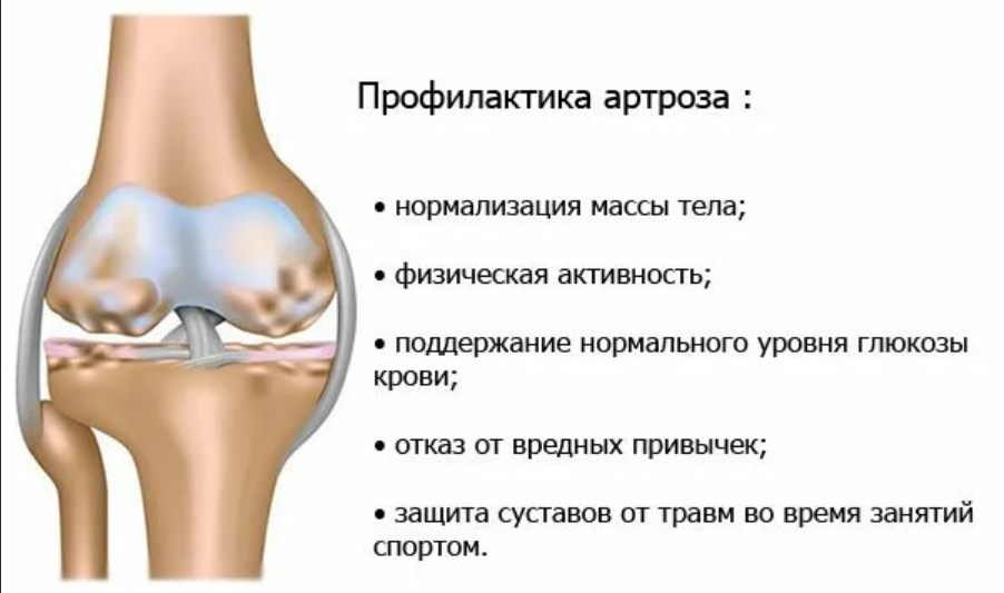 Хрустят суставы как лечить. Деформирующий артроз коленного сустава стадии. Профилактика артрита коленного сустава. Памятка остеоартроз коленного сустава. Ревматоидный гонартроз коленного сустава.