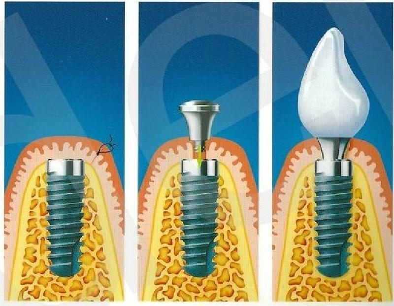 Имплант как ставят зубы пошагово. Имплантат абатмент Noris. Имплант Штрауман этапы. Формирователь на имплант Osstem. Дентальный имплантат операция.