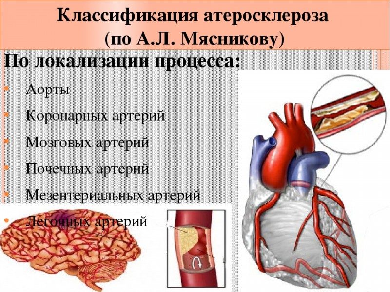 Атеросклеротическое поражение. Классификация атеросклероза коронарных артерий. Атеросклероз аорты и сосудов. Осложнения атеросклероза коронарных артерий. Атеросклероз аорты и коронарных сосудов.