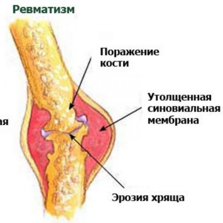 Ревматизм суставов