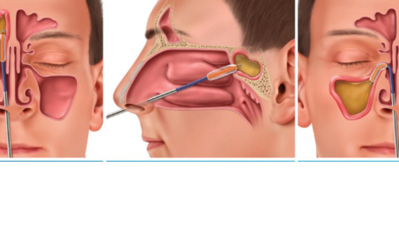 Прокол пазухи при гайморите. Септопластика и гайморит.
