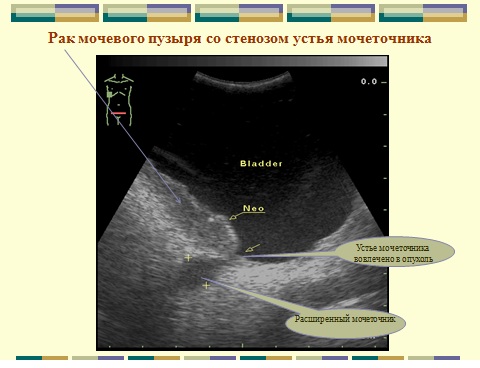 Стенки мочевого пузыря. Расширение устья мочеточника на УЗИ. Стенки мочевого пузыря на УЗИ анатомия. Устье мочеточника на УЗИ. Строение мочевого пузыря на УЗИ.