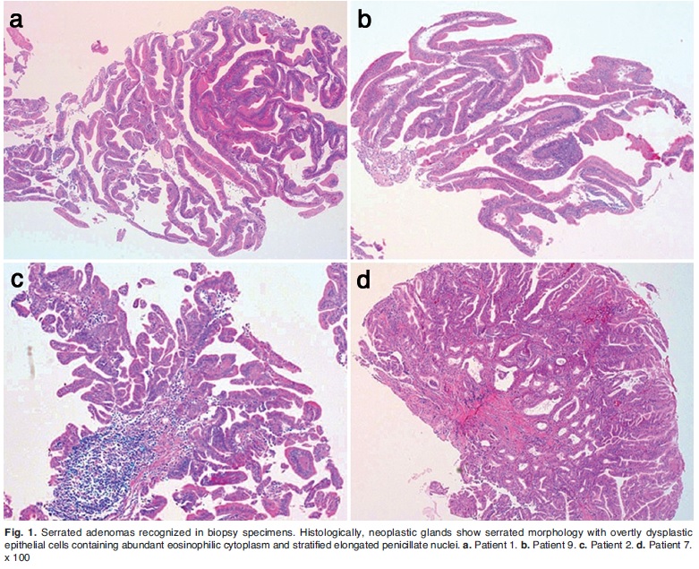 Аденокарцинома g1. Слизеобразующая аденокарцинома гистология. Низкодифференцированная аденокарцинома толстой кишки гистология. Аденокарцинома мочевого пузыря гистология. Аденокарцинома гистология.