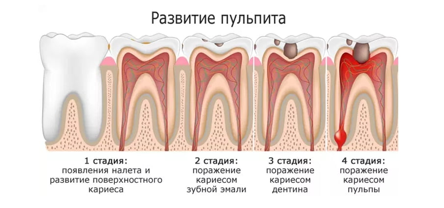 Клиническая картина остаточного пульпита