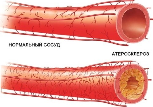 Разрыв кровеносного сосуда. Повреждение сосуда атеросклероз. Атеросклероз (закупорка кровеносных сосудов).