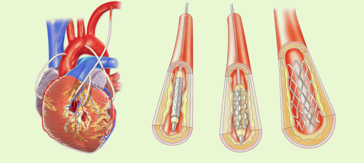 Шунтирование сердца что это такое. Шунтирование сосудов сердца стент. Стенд шунтирование сердца. Операций коронарного шунтирования и стентирования. Шунтирование сердца шрам.