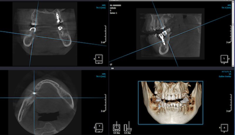 Кт нижней челюсти цена в ульяновске. Дентальная компьютерная 3d томография схема. КЛКТ сегмента челюсти (3-4 зуба).