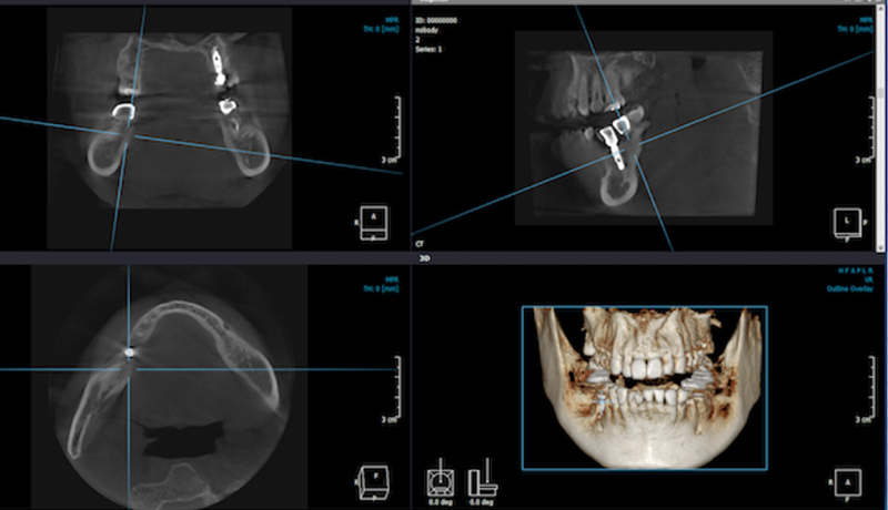 Сделать кт челюсти. Прицельная компьютерная томография зубов. Зубы на снимке кт прицельный. Размеры кт снимков зубов.