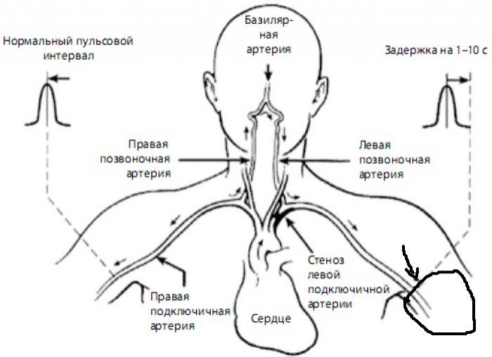 Аберрантная подключичная артерия