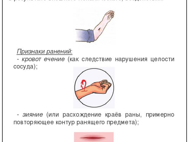 Признаки ранения. Основные симптомы раны.