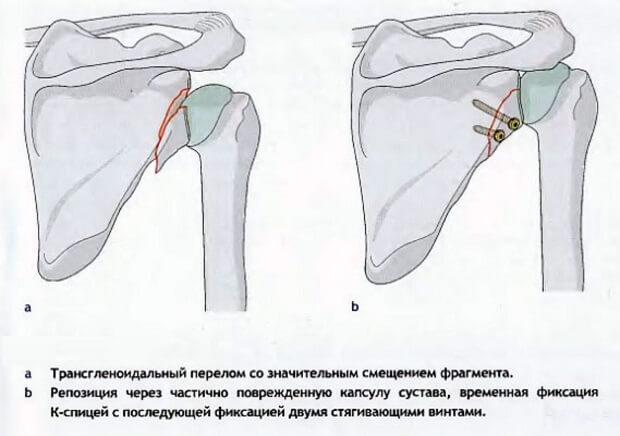 Операция после перелома плеча. Краевой перелом акромиального отростка лопатки. Перелом шейки суставной впадины. Внутрисуставной перелом лопатки. Шейка плечевой кости перелом.
