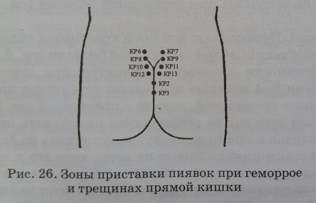 Гирудотерапия при миоме матки схема