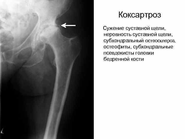 Склероз тазобедренного сустава что это. Субхондральный остеосклероз бедренной кости. Остеосклероз головки бедренной кости. Остеосклероз тазобедренного сустава рентген. Плечевой сустав рентген остеосклероз.