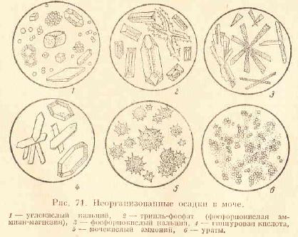 Соли в моче. Микроскопия неорганизованного осадка мочи. Микроскопия кислой мочи. Микроскопия осадка мочи неорганизованный осадок. Патология в моче микроскопия.