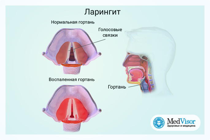 Как восстановить голосовые связки