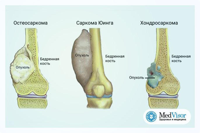 Какие симптомы рака кости. Опухоль Юинга бедренной кости. Опухоли костей и мягких тканей.