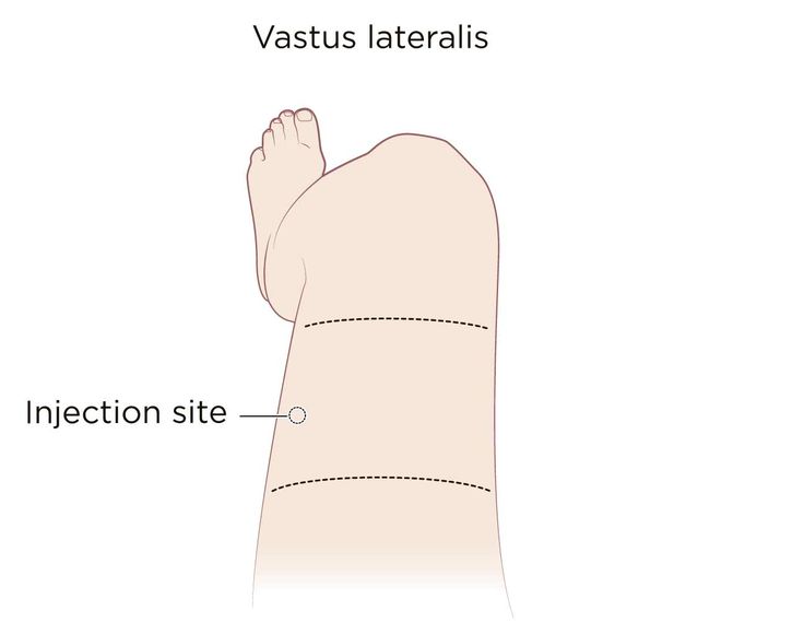 Куда делать укол в ногу внутримышечно схема