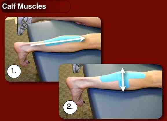 Разрыв икроножной мышцы. Тейп на икроножную мышцу при растяжении. Икроножная мышца разрыв тейп. Тейпирование икроножной мышцы при разрыве. Тейпирование при спазме икроножной мышцы.