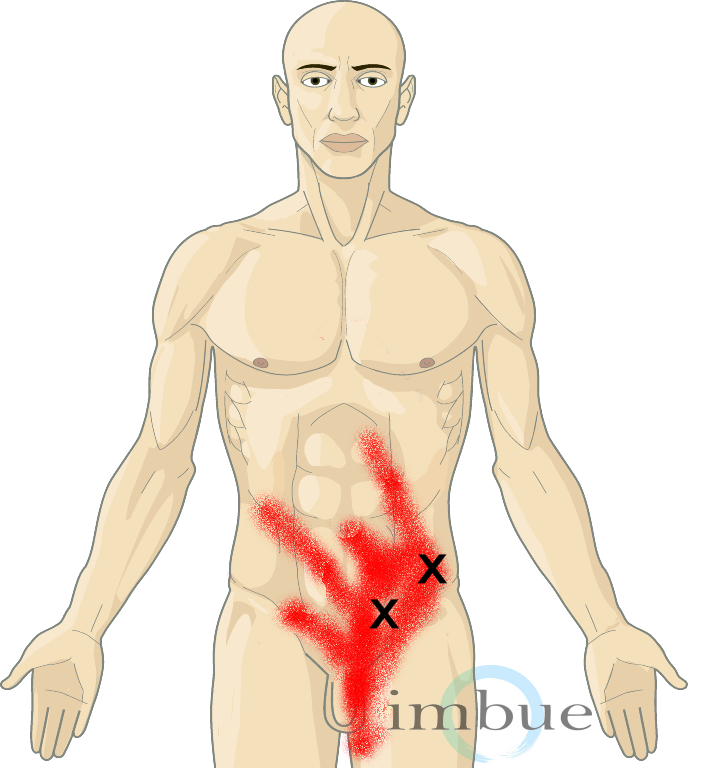 Болит внизу паха слева у мужчин. Триггеры на животе. Триггеры косых мышц живота. Триггерные точки мышц живота. Триггерные точки косых мышц живота.