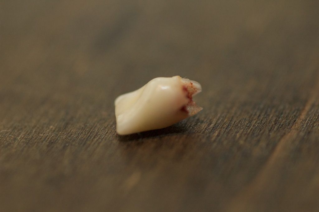 Сонник выпадение зубов без крови