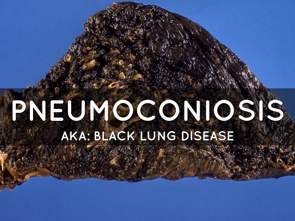 Пневмокониоз. Pneumoconiosis is.