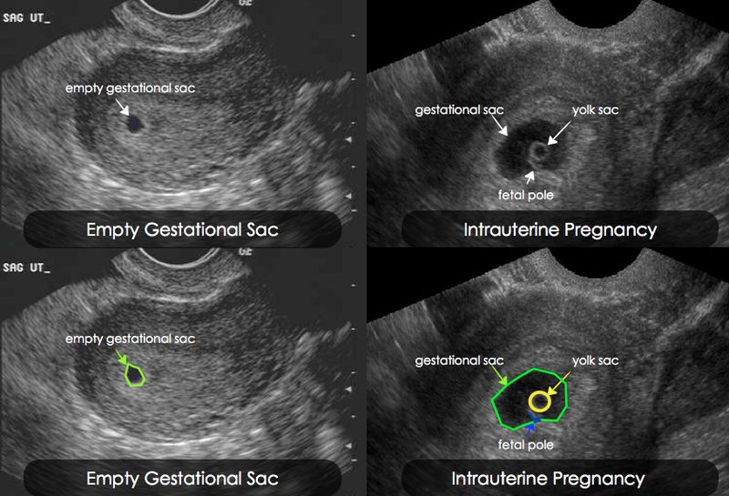 Как отличить на узи. Внематочная беременность на УЗИ на ранних. УЗИ внематочной беременности на раннем сроке фото. Внематочная Трубная беременность УЗИ. На УЗИ внематочная беременность - показать.