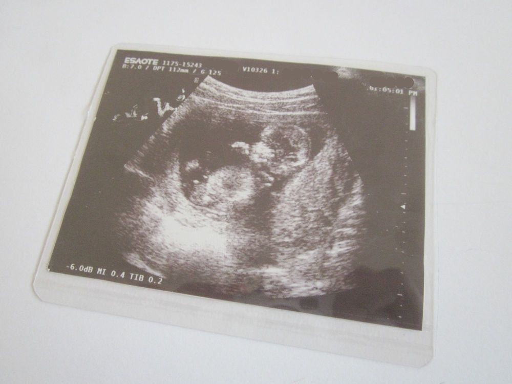 Фото с узи беременных на маленьком сроке