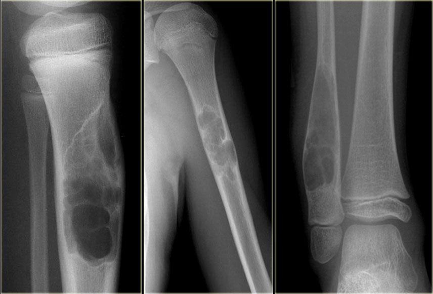 Опухоли лучевой кости. Остеоид остеома рентген. Остеома бедренной кости. Экзостоз плечевой кости.
