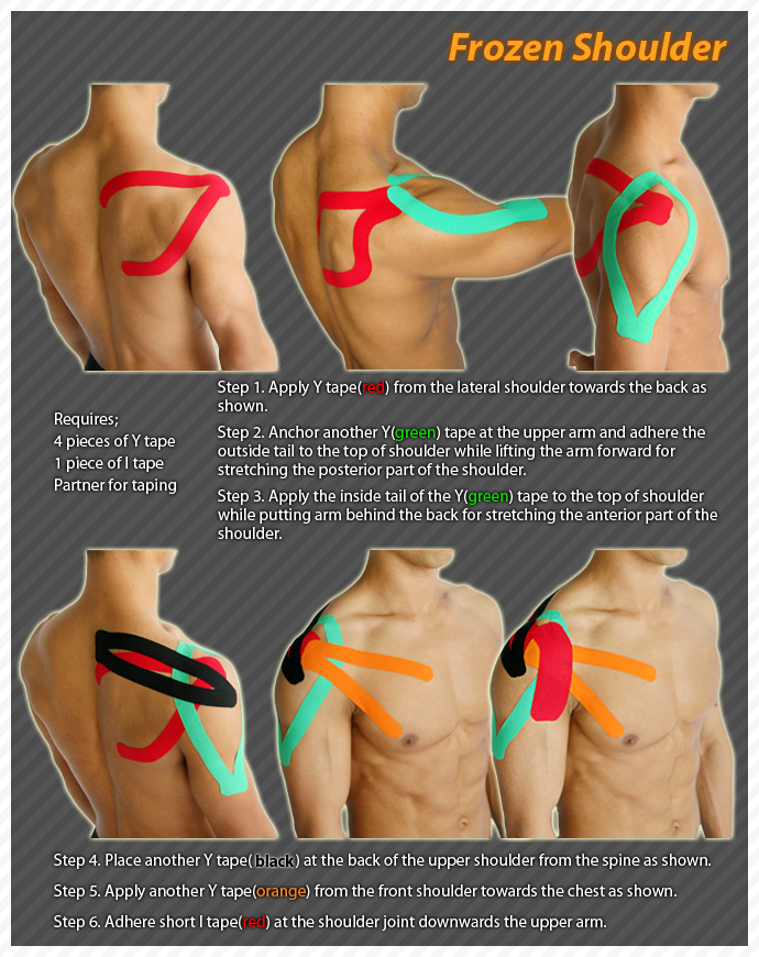 После операции болят плечи. Растяжение связок плечевого сустава тейпирование. Схема фиксации плечевого сустава тейпом. Схема тейпирования связок плечевого сустава. Тейпирирование лопатки и плеча.