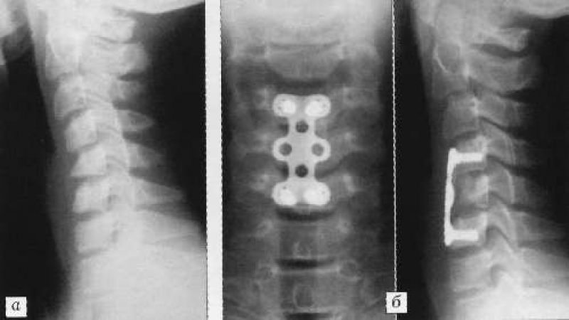 Перелом шейного позвонка фото