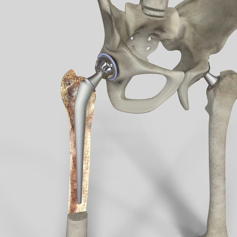 Титановый тазобедренный протез