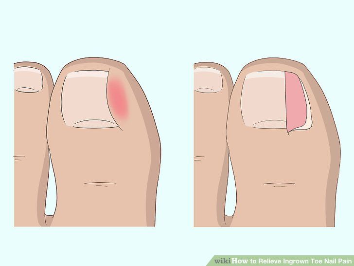 Врезаются ногти что делать. Онихокриптоз вросший ноготь операция. Вырезать вросший ноготь. Степени врастания ногтя.