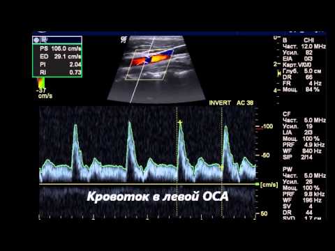 Узи бца что это. ЦДС брахиоцефальных сосудов. ЦДС сосудов головы и шеи. Что такое УЗИ ЦДС бца. . Ультразвуковое исследование сосудов цбигел.