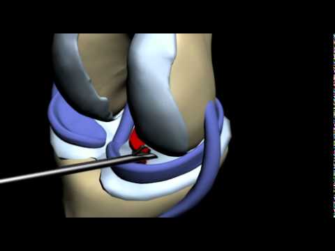 Резекция мениска. Разрыв мениска операция. Менископатия внутреннего мениска. Резекция медиального мениска. Разрыв мениска коленного сустава операция.