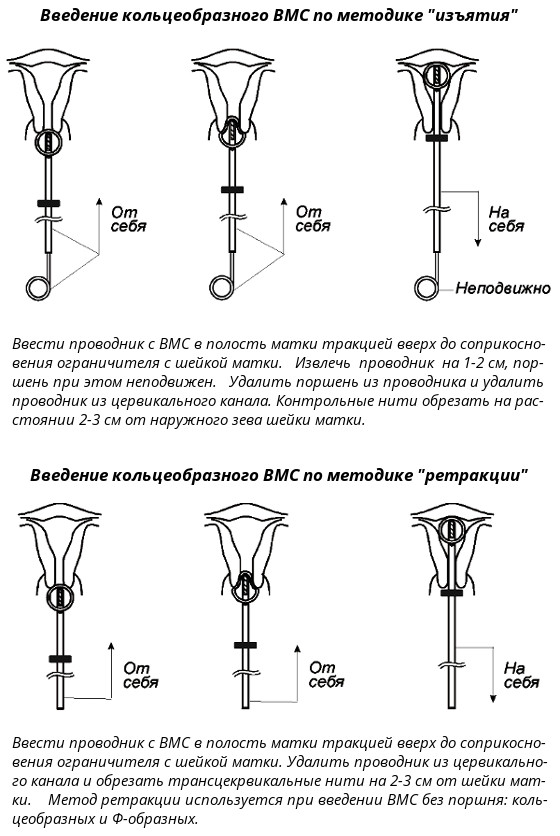 После введения вмс. Методики введения спирали. Техника постановки ВМС спирали. Введение внутриматочной спирали алгоритм.