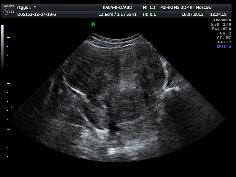 Снимок узи матки. Некроз миоматозного узла на УЗИ. УЗИ признаки миомы тела матки.