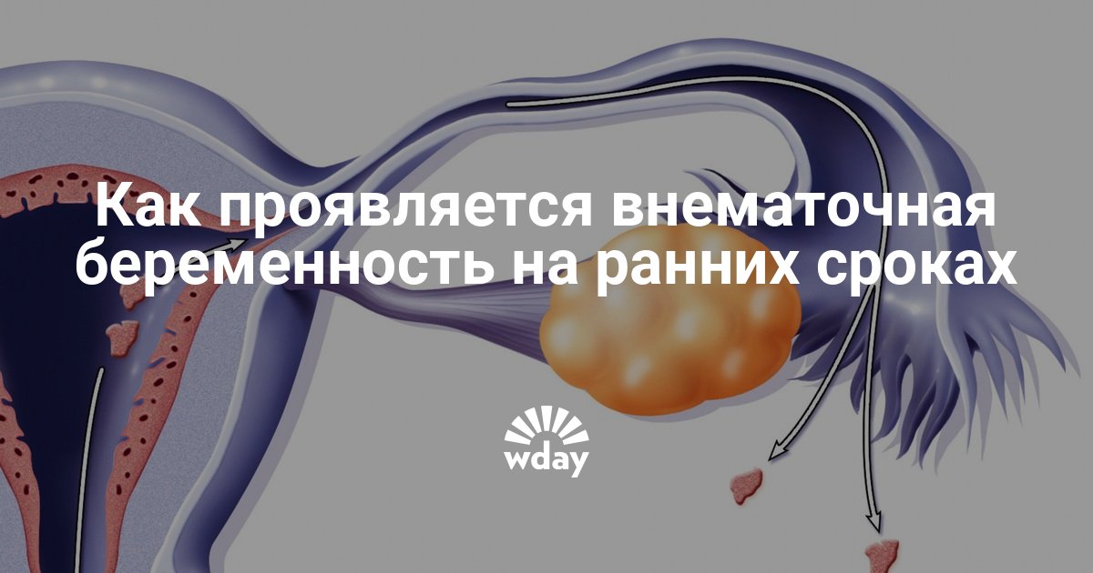 Внематочная беременность на ранних сроках. Внематочная беременность симптомы на ранних сроках. Внематочная на раннем сроке. Внематочная выделения.