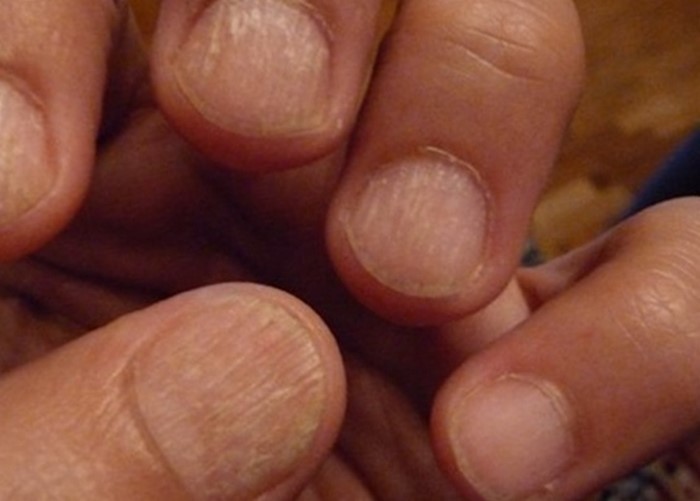 Ребристые ногти причина у мужчин. Ониходистрофия - онихолизис.. Негрибковые заболевания ногтей. Псориатическая ониходистрофия ногтей.