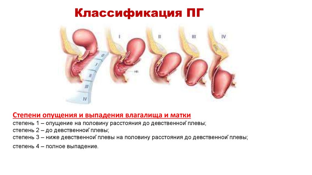 Как выглядит опущение матки и шейки на картинке