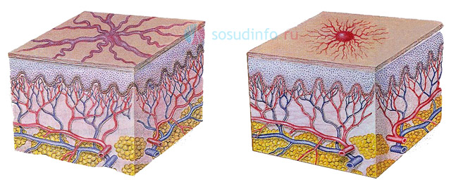 Кровеносные сосуды кожи. Ангиома телеангиэктазия. Паутинчатая гемангиома.