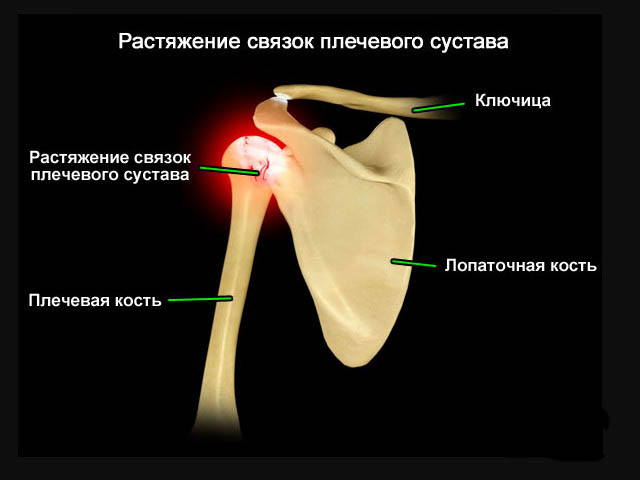 Разрыв плечевого сустава симптомы. Повреждение КСА плечевого сустава. Неполный разрыв плечевого сустава. Растяжение капсулярно-связочного аппарата поеча. Надрыв связок плечевого сустава.