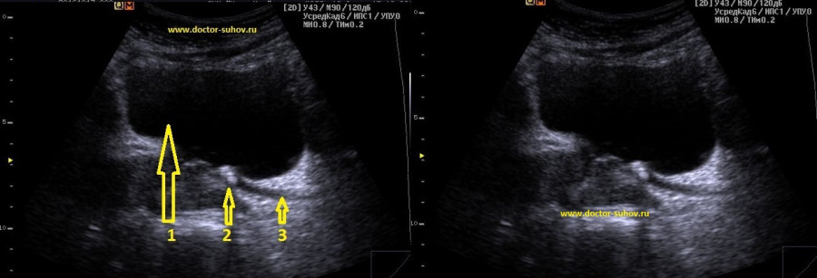 Узи остаточной мочи. Камень в Устье мочеточника на УЗИ. Камень нижней трети мочеточника УЗИ. Камень мочевого пузыря в Устье мочеточника по УЗИ. Камень в мочеточнике по УЗИ.