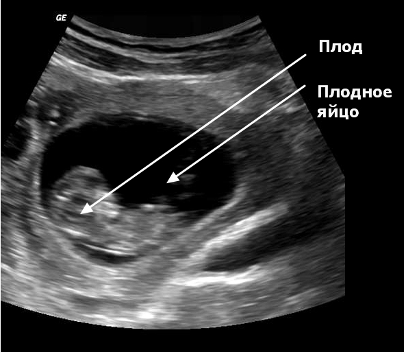 На узи видно внематочную. Внематочная Трубная беременность УЗИ.